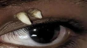 眼皮一肿，为什么先想到囊肿、炎症、肿瘤，偏偏想不到一颗牙？